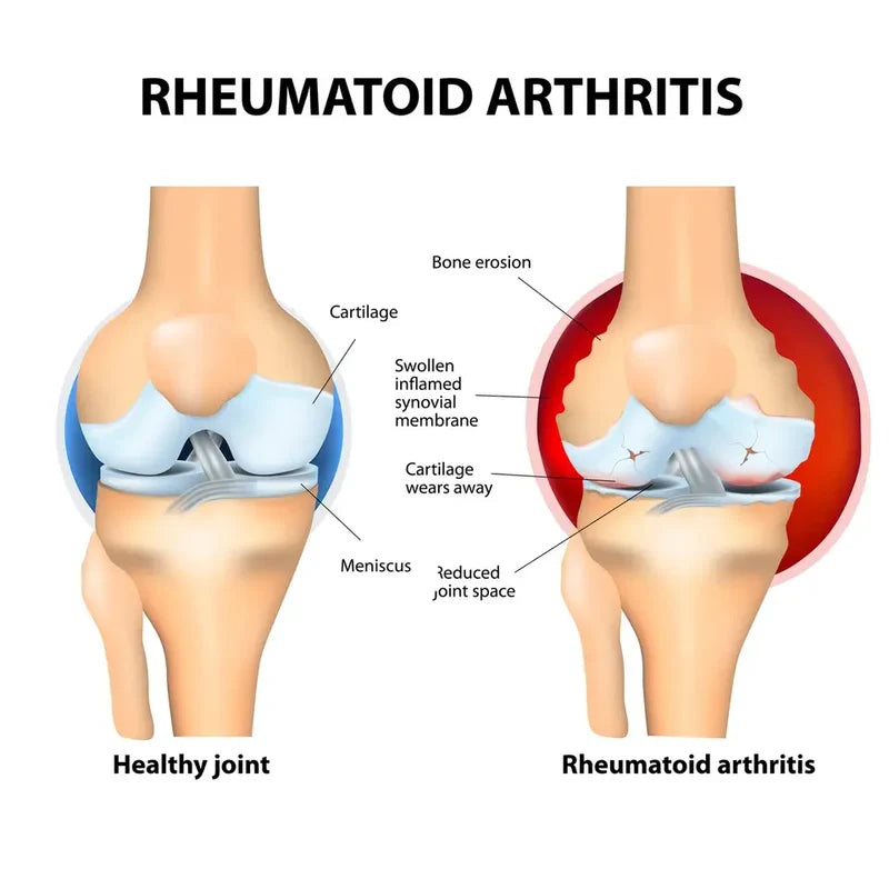 Arthritis Pain Relief Cream